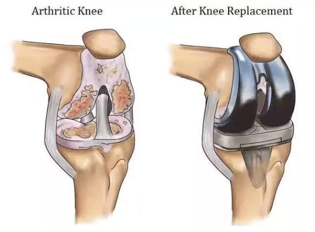 नी रिप्लेसमेंट सर्जरी ( KNEE REPLACEMENT SURGERY )